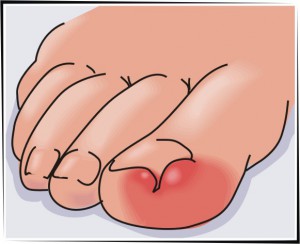 Лечение вросшего ногтя лазером